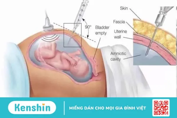 Chọc ối có đau không? Liệu có ảnh hưởng đến thai nhi?