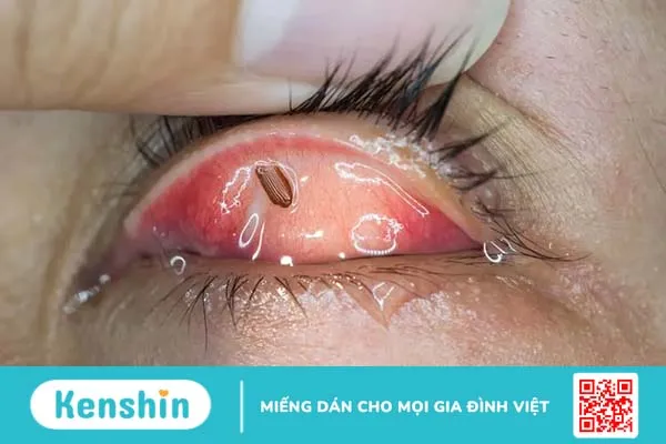 Chớp mắt thấy đau do đâu? 9 nguyên nhân thường gặp và cách trị