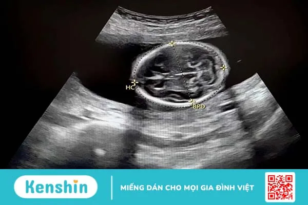 Chu vi vòng đầu thai nhi: Chỉ số quan trọng ảnh hưởng sức khỏe mẹ và bé