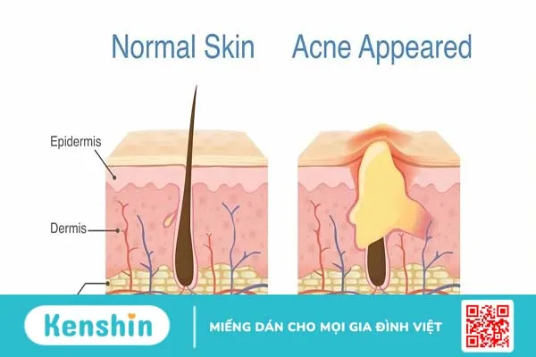 Chữa mụn trứng cá: uống Acnotin bao lâu thì hết mụn?