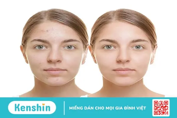 Chữa mụn trứng cá: uống Acnotin bao lâu thì hết mụn?