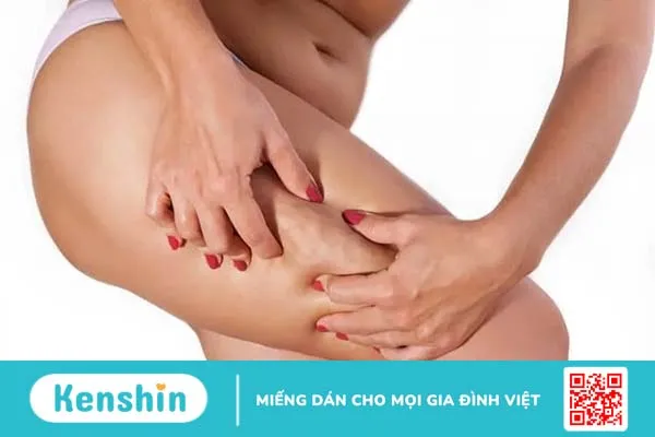 Chữa rạn da đùi để tự tin mặc váy ngắn