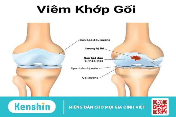 Chữa thoái hóa khớp gối tại nhà: 9 biện pháp hiệu quả