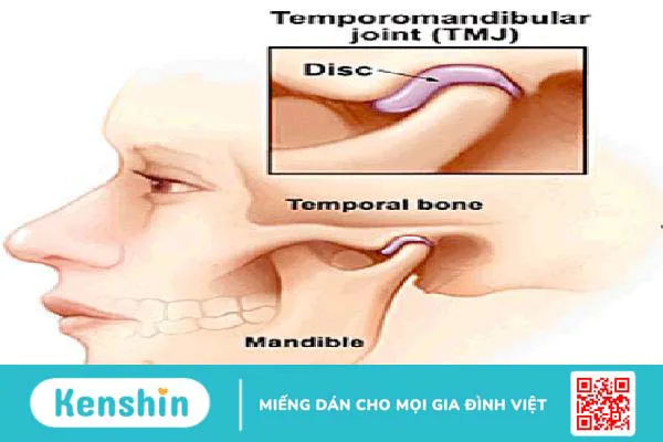 Chứng rối loạn khớp thái dương hàm