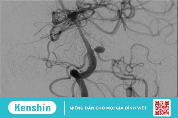 Chụp mạch máu kỹ thuật số hóa xóa nền (DSA)