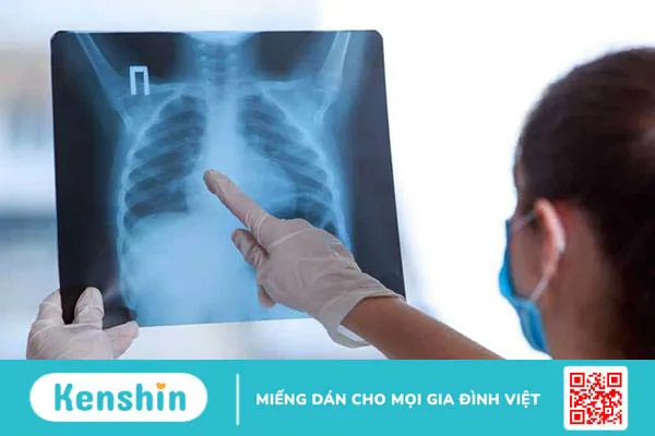 Chụp X quang tràn dịch màng phổi có giúp chẩn đoán bệnh?