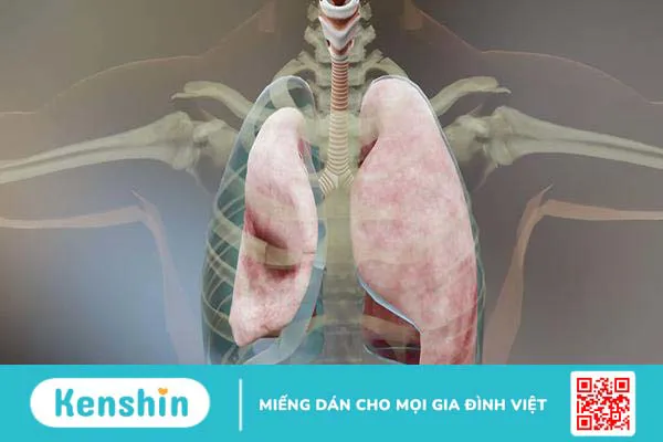 Chụp X quang tràn dịch màng phổi có giúp chẩn đoán bệnh?