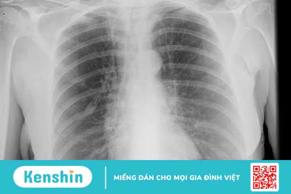 Chụp X-quang trong COPD có hiệu quả?