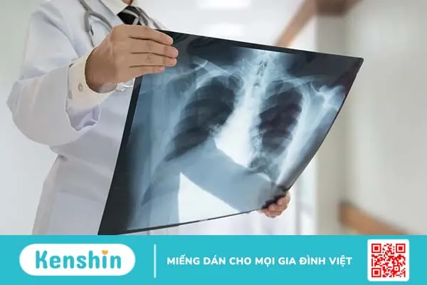 Chụp X quang ung thư phổi và những điều bạn cần biết