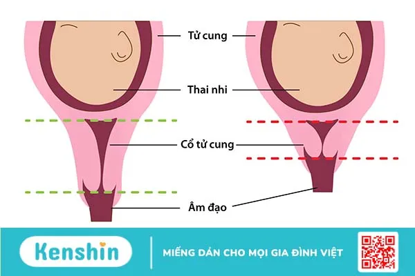 Chuyên gia giải đáp: Cổ tử cung ngắn khi mang thai là gì, có sao không?