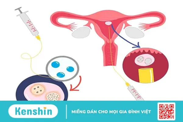 Chuyên gia giải đáp: Sau khi chọc hút trứng bao lâu thì chuyển phôi?