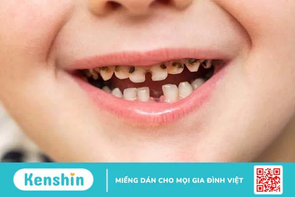 Chuyên gia nha khoa giải đáp: Trẻ bị sún răng sữa phải làm sao?