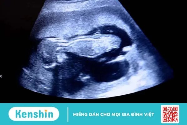 Chuyên gia sản khoa giải mã nguyên nhân độ mờ da gáy cao ở thai nhi