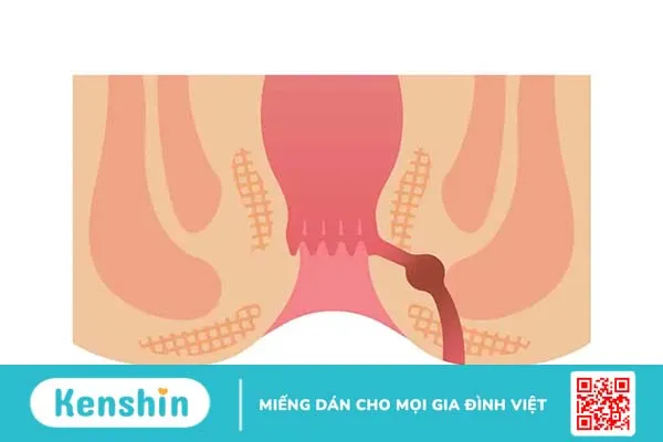 Có cách chữa rò hậu môn tại nhà không? Cách điều trị rò hậu môn đạt hiệu quả