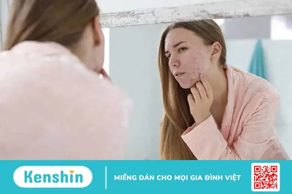 Có nên đi nặn mụn ở spa? Những lưu ý khi nặn mụn