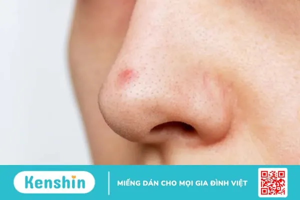 Có nên sử dụng sản phẩm non comedogenic khi chăm sóc da?