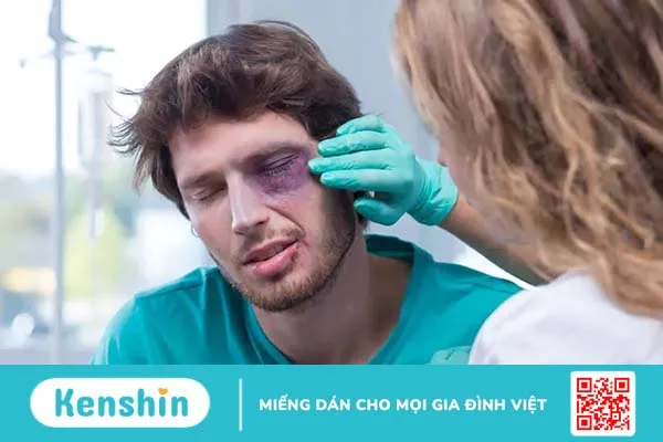 Có phải tự nhiên bị bầm tím mắt và cách làm tan vết bầm nhanh nhất