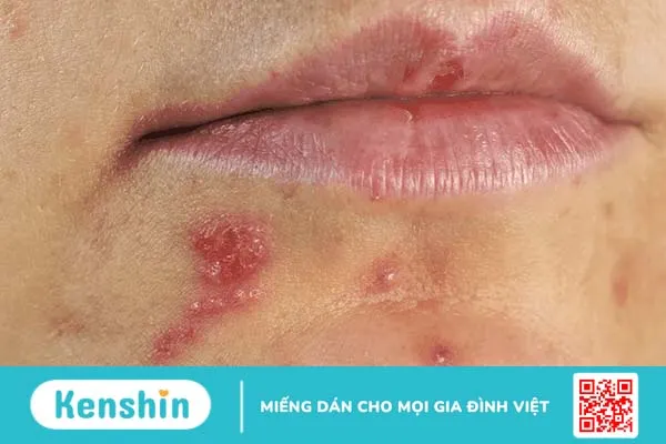 Có thể bạn không biết mình đã mắc virus herpes simplex