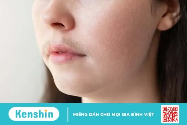 Con gái có ria mép: Nguyên nhân và cách xử lý triệt để