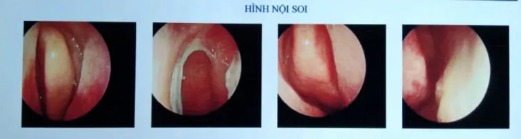 Concha bullosa là gì và khi nào cần phải phẫu thuật loại bỏ nó đi?