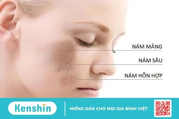 Công nghệ làm đẹp da mesotherapy là gì?