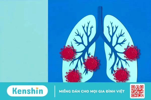 Cúm A có nguy hiểm không? Làm gì để phòng tránh biến chứng cúm A?