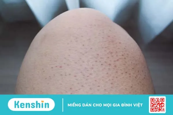 Da bị nổi sần như da gà và ngứa: Cảnh báo bệnh Keratosis pilaris