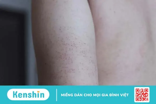 Da bị nổi sần như da gà và ngứa: Cảnh báo bệnh Keratosis pilaris