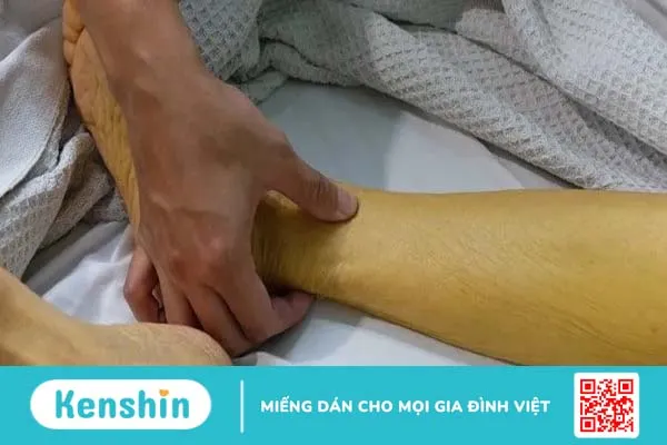 Da bị vàng là thiếu chất gì và cách khắc phục, ngăn ngừa