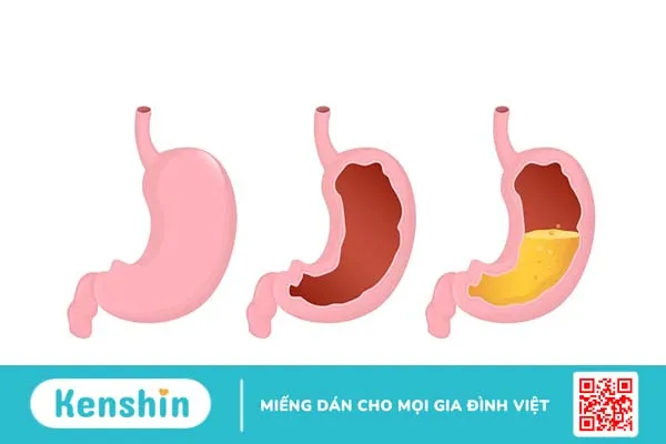 Dạ dày nằm ở đâu, có chức năng gì? Các bệnh dạ dày và cách ngừa bệnh