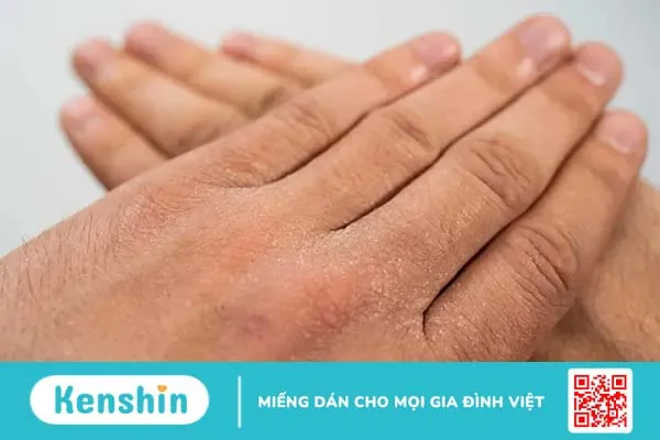 Da khô sần sùi: Nguyên nhân và cách điều trị hiệu quả