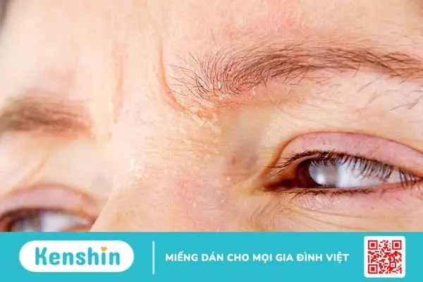 Da mặt bị ngứa sần sùi phải làm sao? 8 cách điều trị an toàn, hiệu quả