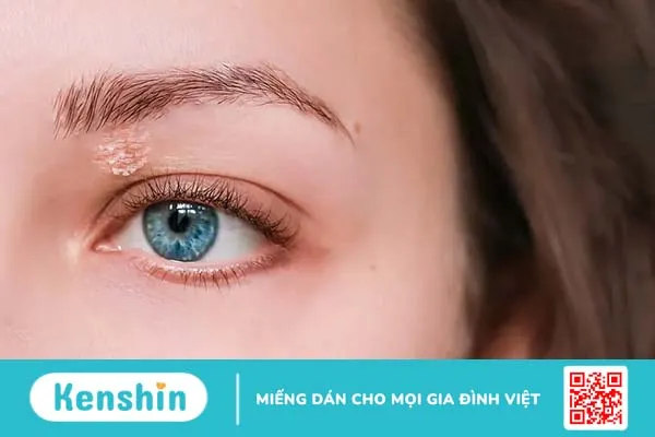 Da mặt bị ngứa sần sùi phải làm sao? 8 cách điều trị an toàn, hiệu quả