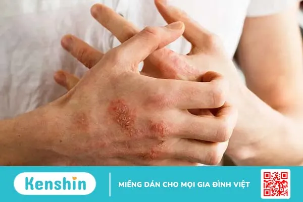 Da nổi mẩn đỏ ngứa: 15 “thủ phạm” và cách kiểm soát hiệu quả