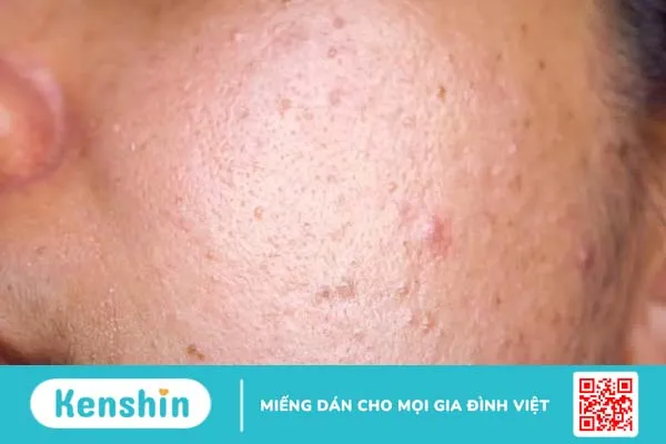 Da sần sùi mụn ẩn: Nguyên nhân, dấu hiệu, cách điều trị và phòng ngừa