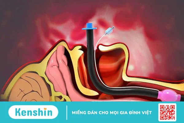 Đặt nội khí quản: Chỉ định, quy trình thực hiện, biến chứng và lưu ý