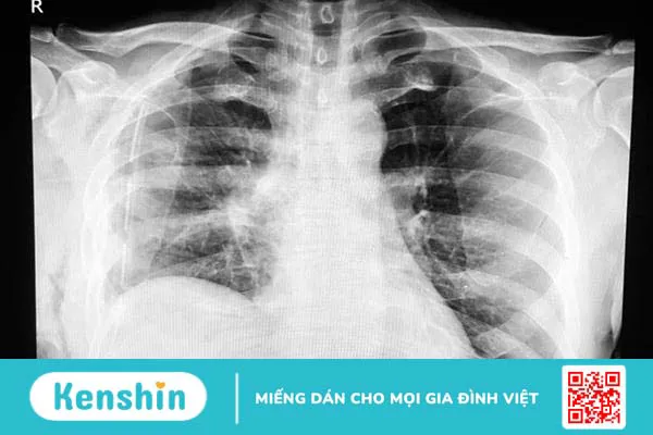 Đặt ống dẫn lưu màng phổi