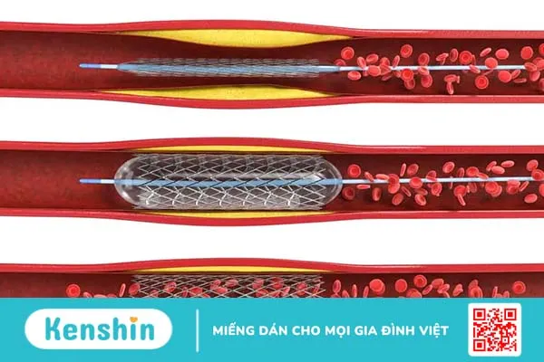 Đặt stent là gì? Quy trình và biến chứng thường gặp