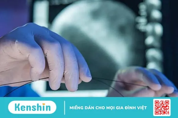 Đặt stent là gì? Quy trình và biến chứng thường gặp