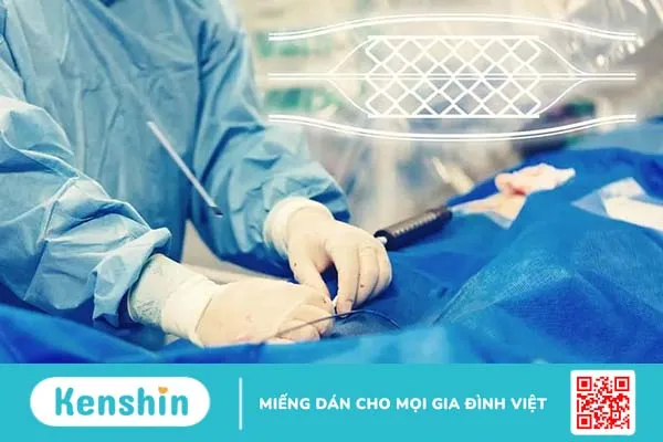 Đặt stent là gì? Quy trình và biến chứng thường gặp