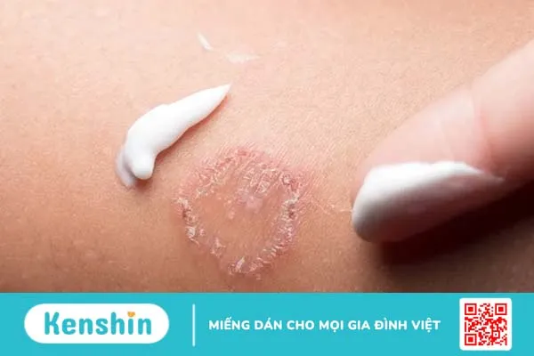 Dấu hiệu bệnh hắc lào: Biểu hiện dễ nhận biết nhất