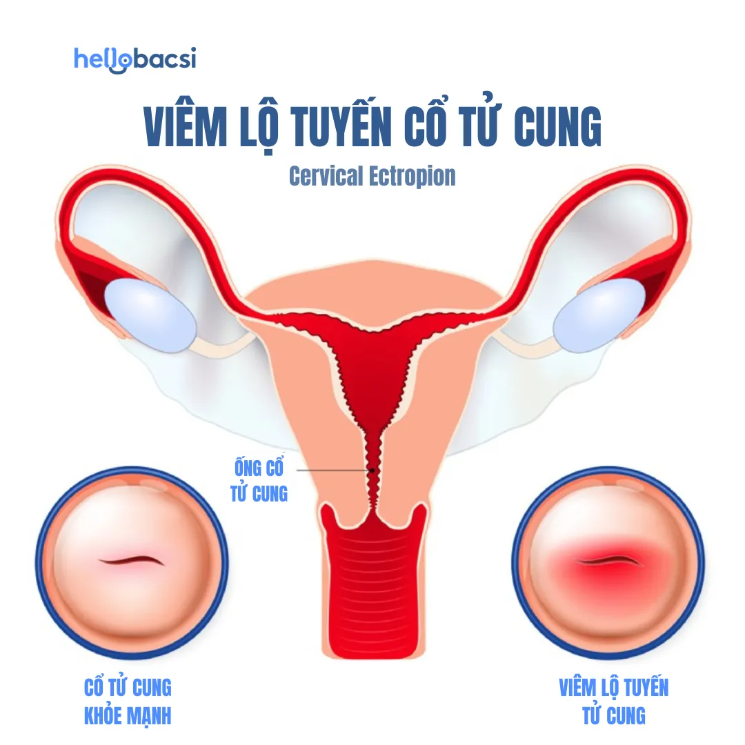 Dấu hiệu khỏi bệnh viêm lộ tuyến cổ tử cung