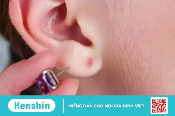 Dấu hiệu nhiễm trùng khi bấm lỗ tai và cách xử trí