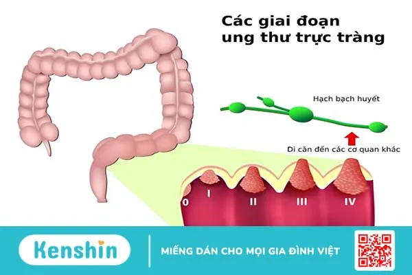 Dấu hiệu ung thư trực tràng là gì? Có nguy hiểm không?