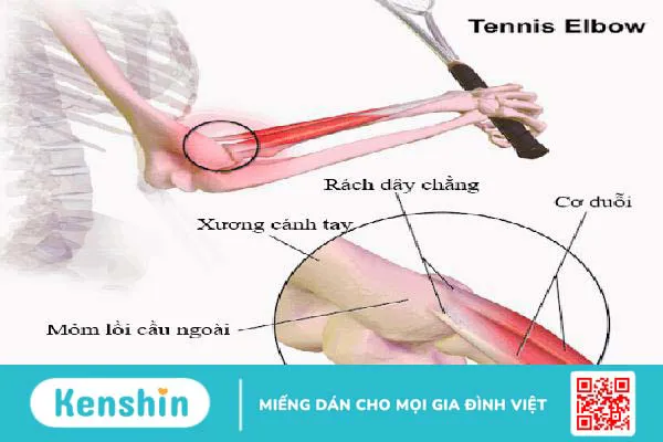 Đau khuỷu tay và những điều bạn cần biết