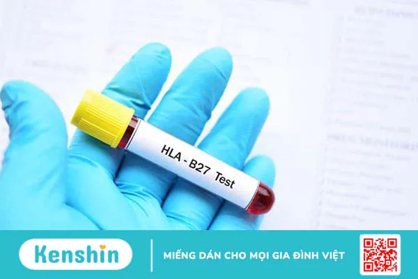 Đâu là các xét nghiệm giúp chẩn đoán bệnh viêm cột sống dính khớp?