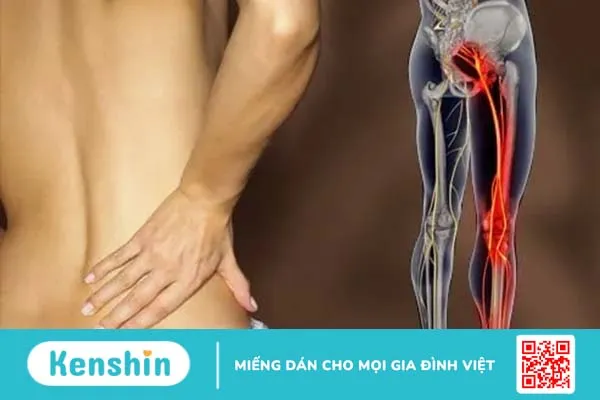 Đau thần kinh tọa Đau thần kinh tọa