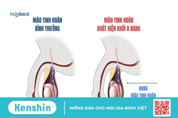 Đau tinh hoàn bên trái: Nguyên nhân, triệu chứng, điều trị, phòng ngừa