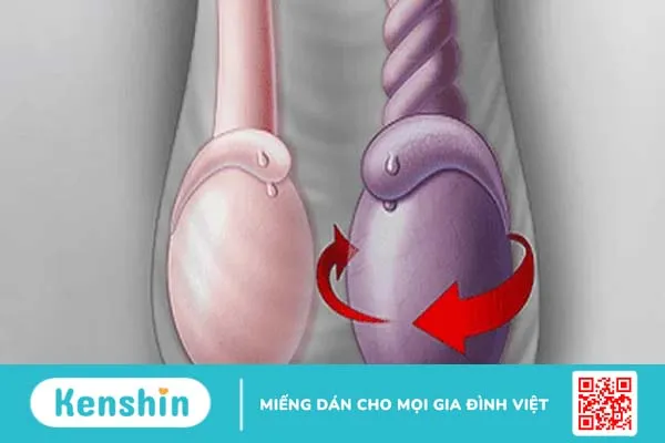 Đau tinh hoàn là bệnh gì? Nguyên nhân, triệu chứng và cách điều trị