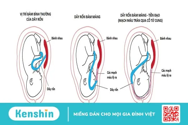 Dây rốn bám màng: Tình trạng hiếm gặp nhưng nguy hại cho em bé